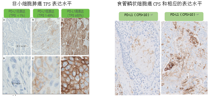 围观病理科可开展免疫治疗的pdl1免疫组化检测啦