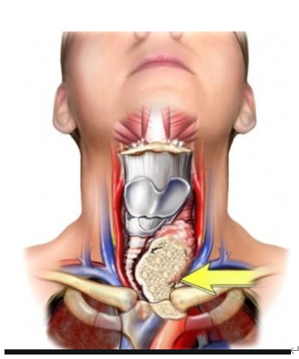 甲状腺癌淋巴结转移图片