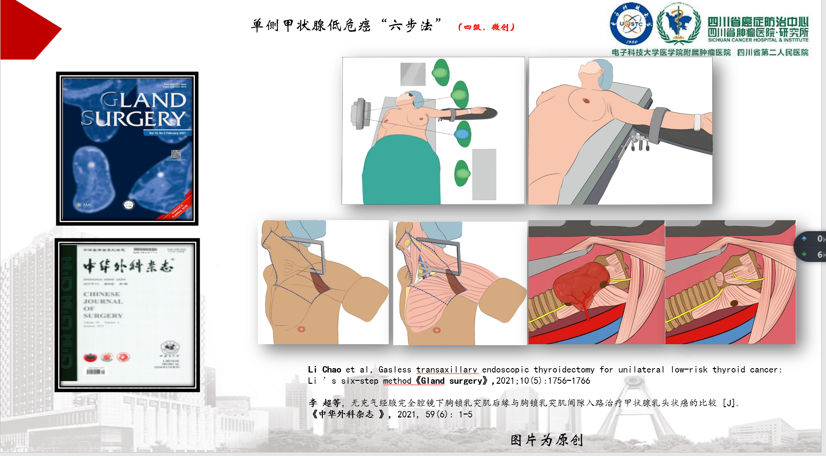 国内首部头颈外科中心参与执笔起草的国内首部腋窝入路腔镜甲状腺手术