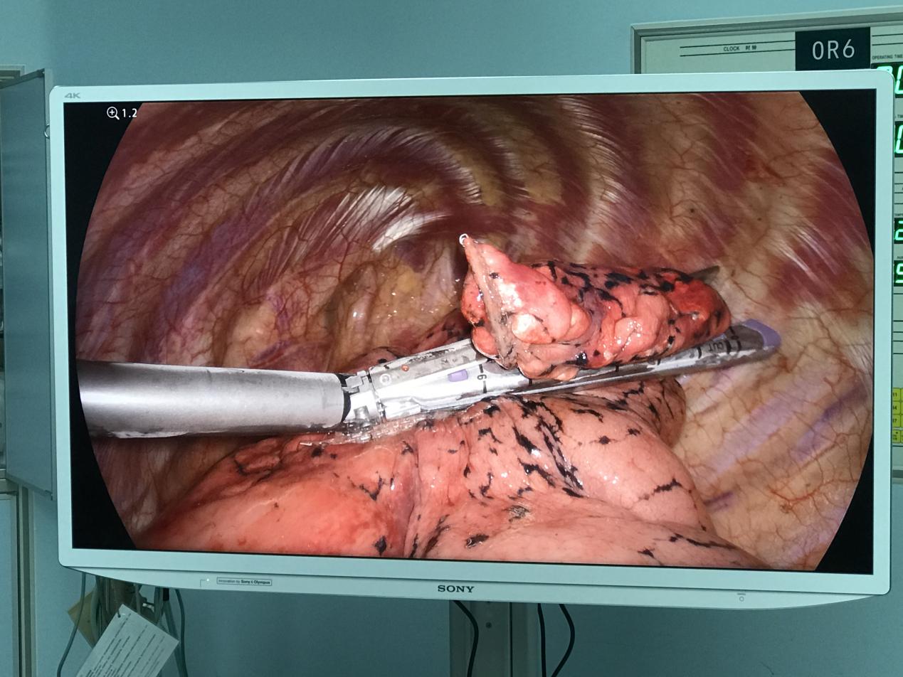 为该患者实施胸腔镜下左上肺楔形切除和左上