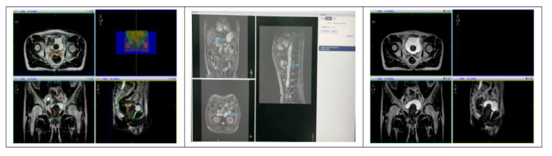 医院购入设备怎么记特别“费”医生的4号机放疗——记腹部放疗一病区MRI-linac Unity临床应用_https://www.jmylbn.com_新闻资讯_第1张
